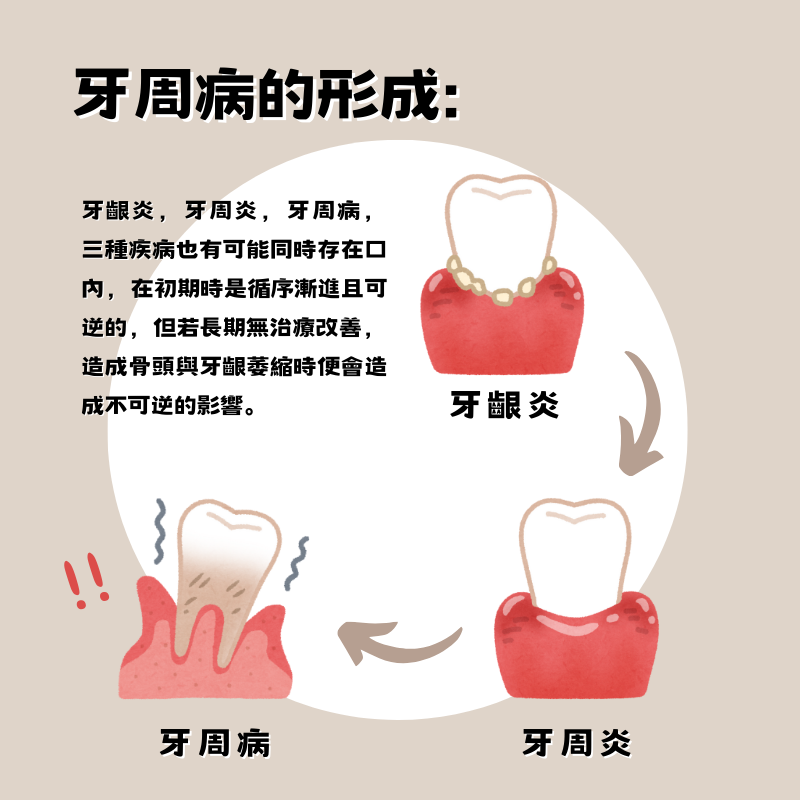 牙周病發展進程